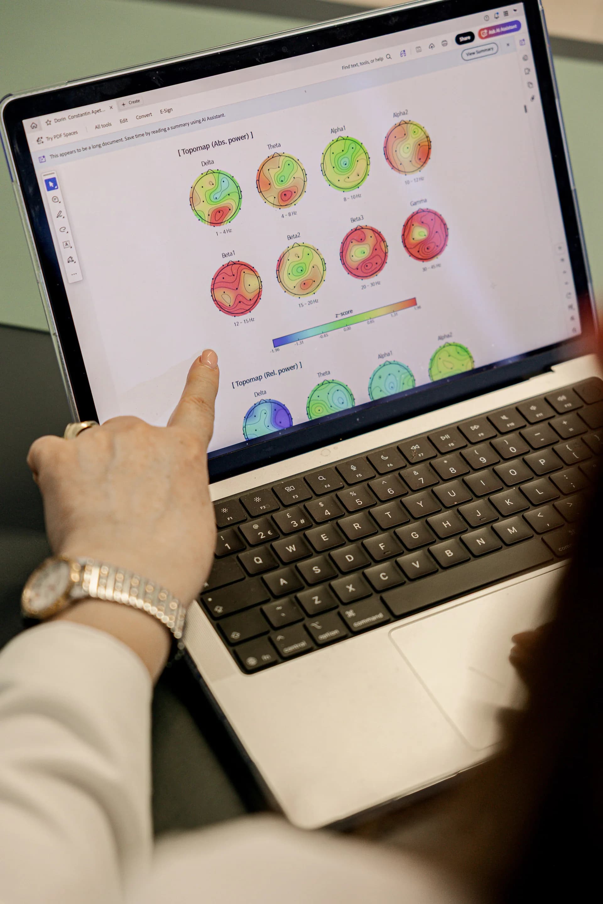 iSyncBrain QEEG analysis report showing brain activity patterns